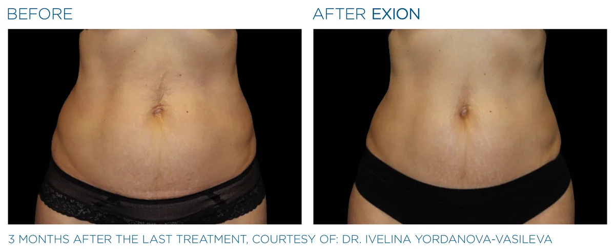 Before and after EXION Body clinical result.