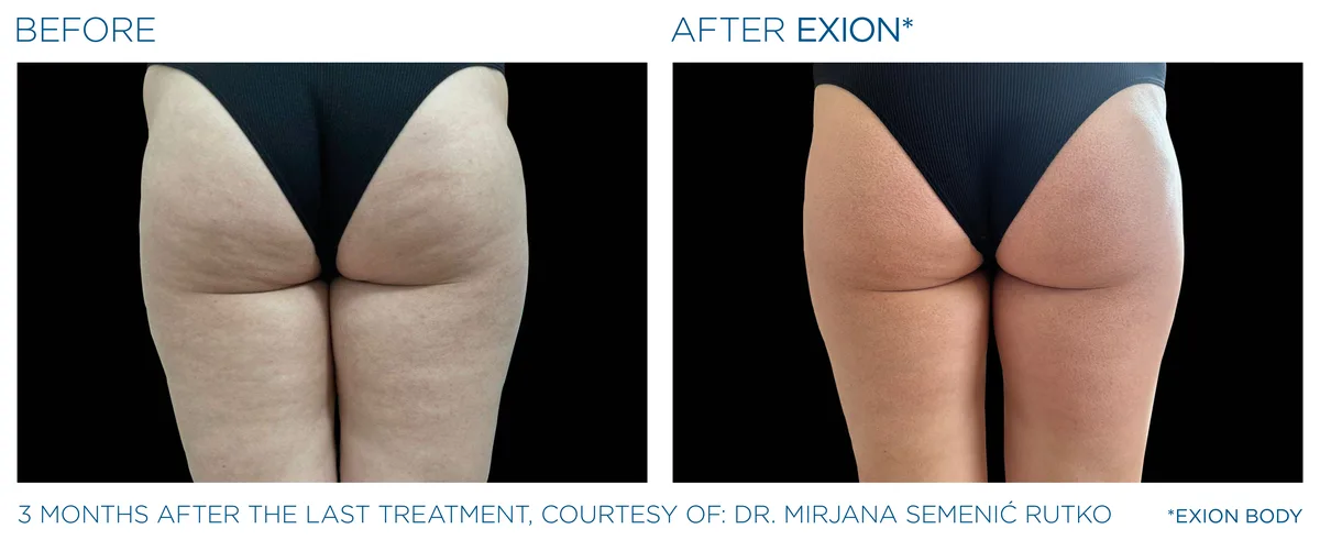 EXION Buttocks before and after result example