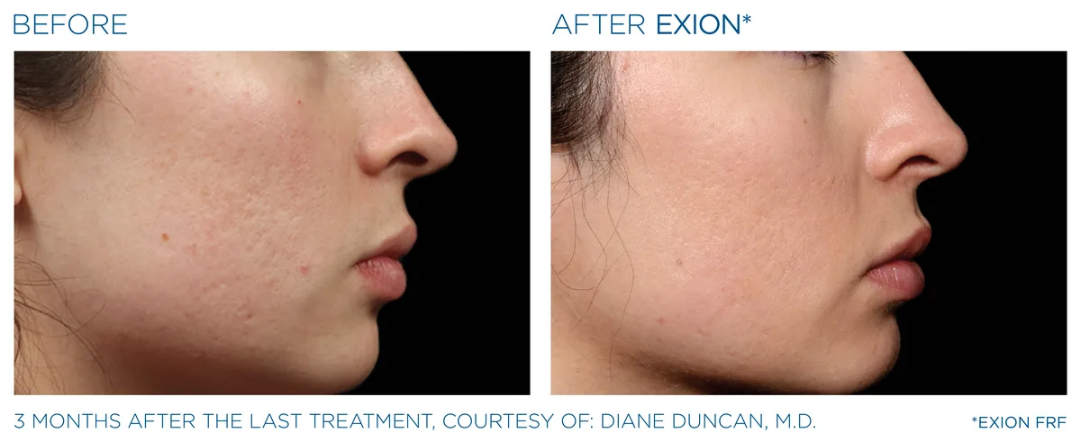 EXION Cheek before and after result example