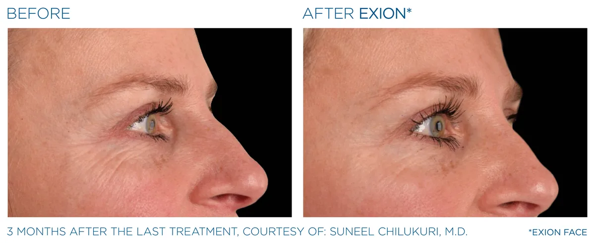 EXION Eyes before and after result example