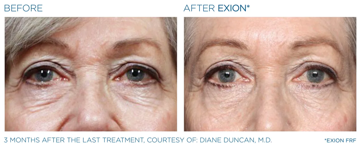 EXION RF microneedling eyes before and after result example