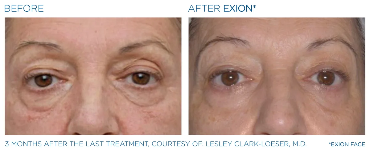 EXION Eyes before and after result example