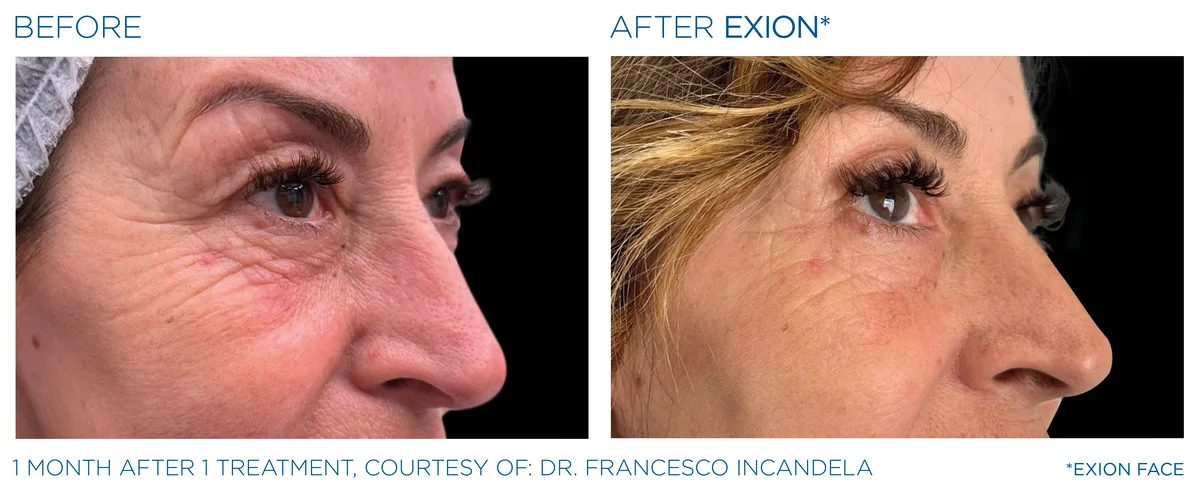 EXION Eyes before and after result example