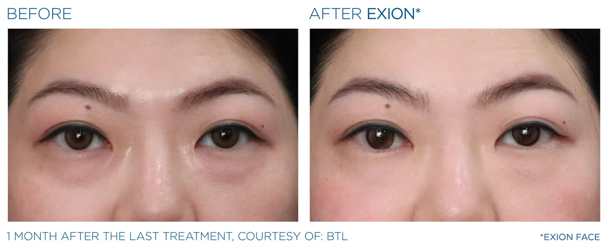 EXION Eyes before and after result example