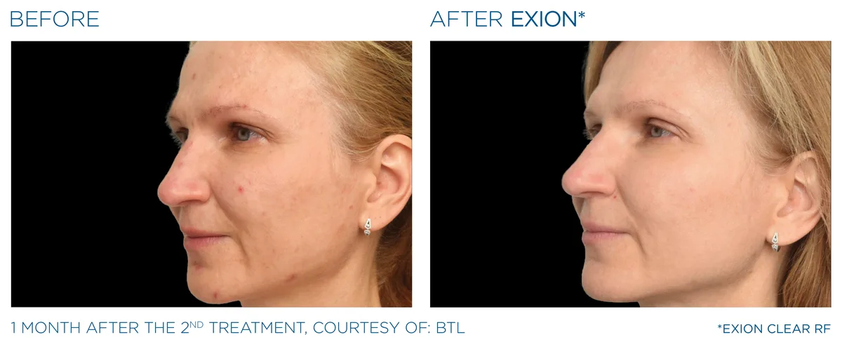 Before and after EXION ClearRF clinical result.