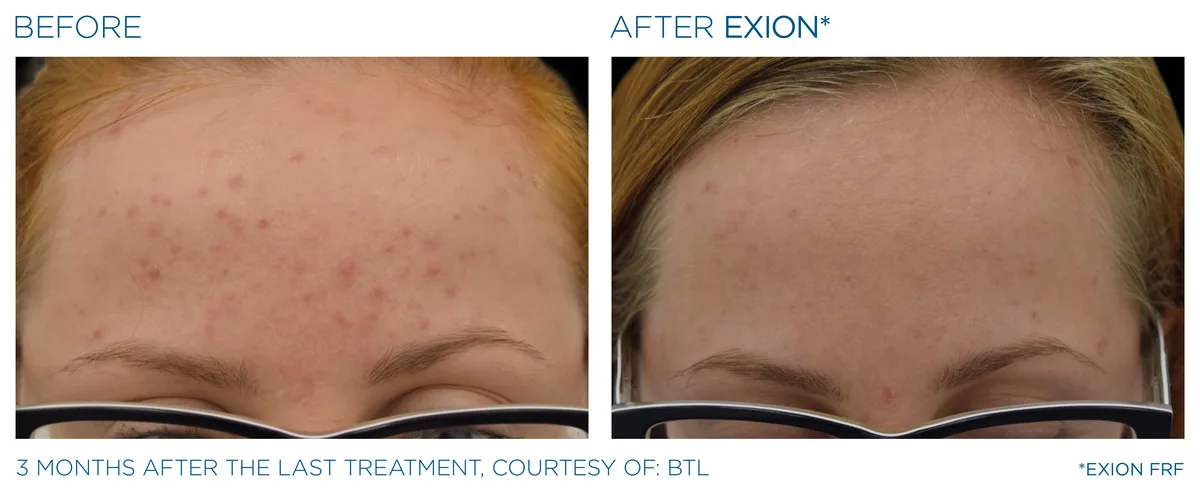 Before and after EXION RF microneedling clinical result.