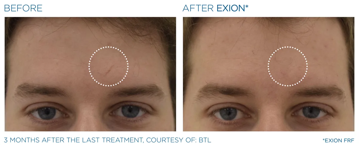EXION Forehead before and after result example