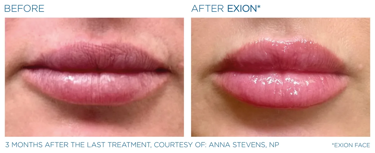 EXION Face before and after result example