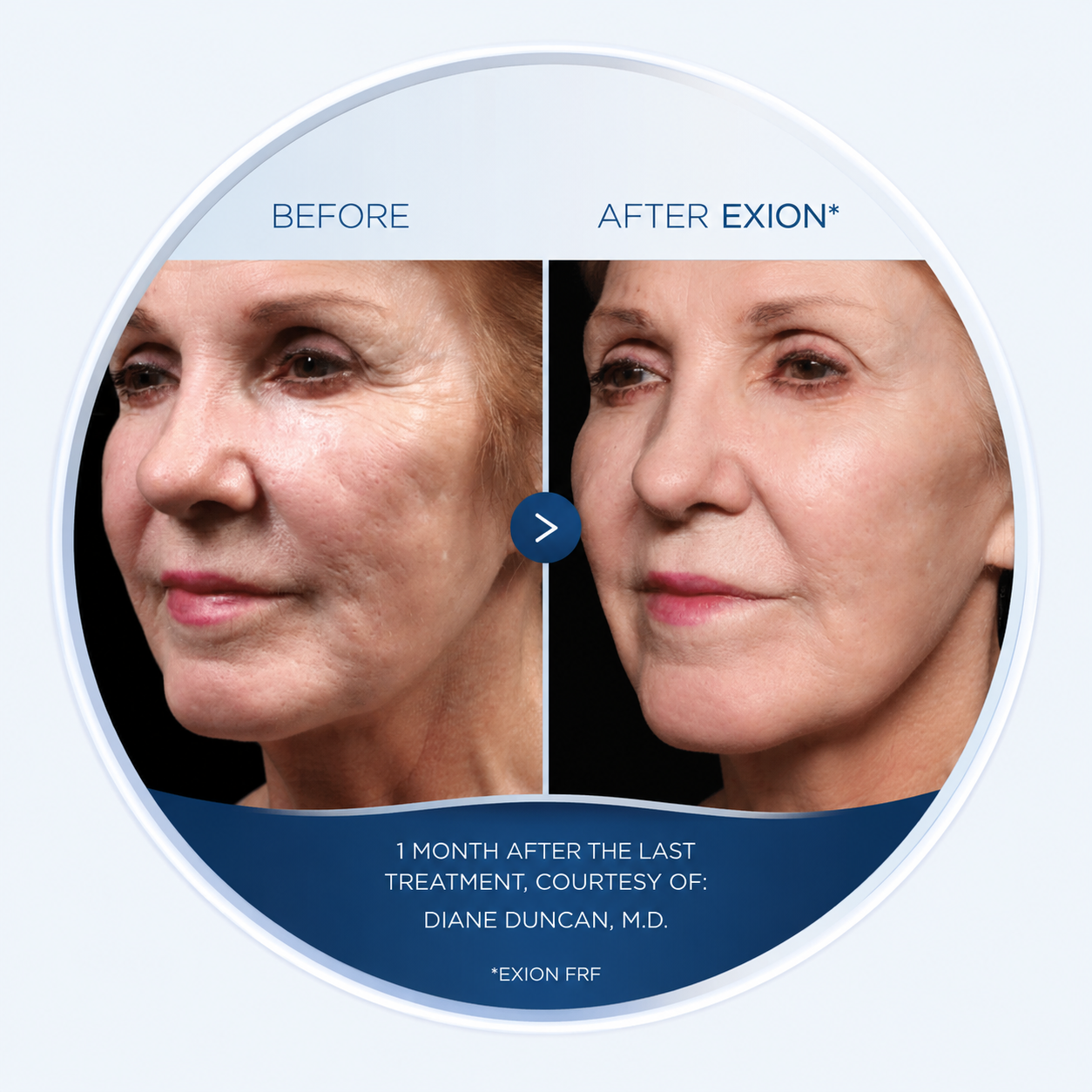 Before and after EXION RF microneedling facial result, courtesy Diane Duncan, M.D.