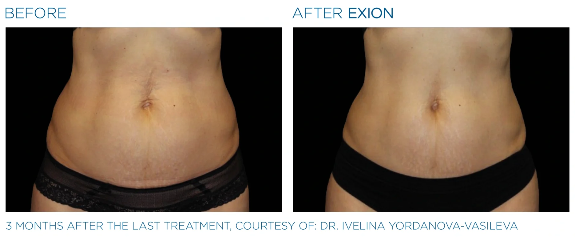 Before and after EXION Body abdomen result, courtesy Dr. Ivelina Yordanova-Vasileva