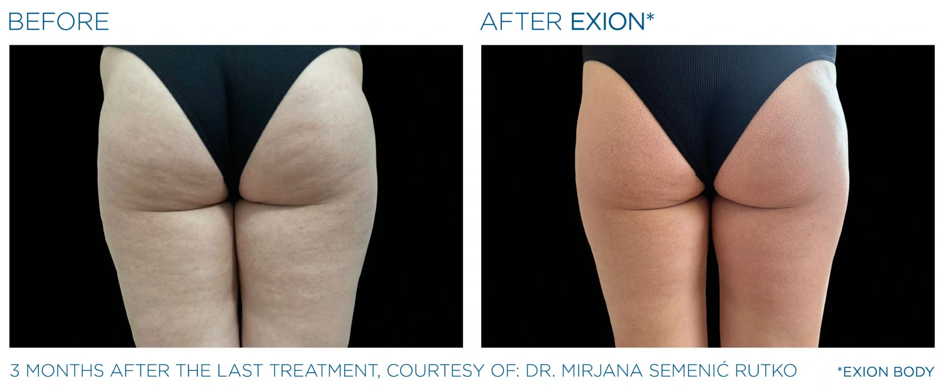 Before and after EXION Body buttocks result, courtesy Dr. Mirjana Semenic Rutko