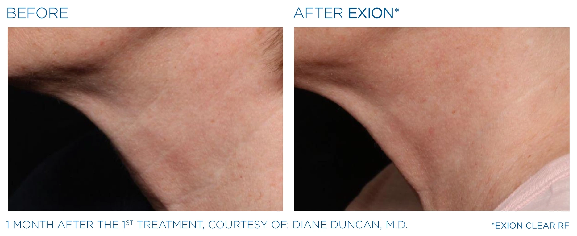 Before and after EXION ClearRF neck result, courtesy Diane Duncan, M.D.