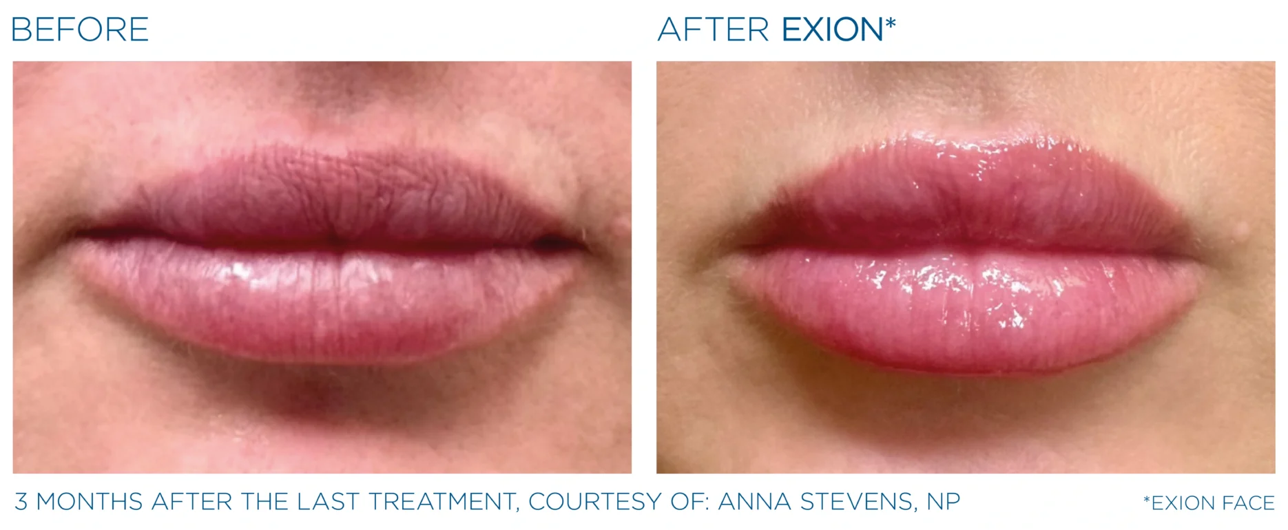 Before and after EXION Face mouth-area result, courtesy Anna Stevens, NP