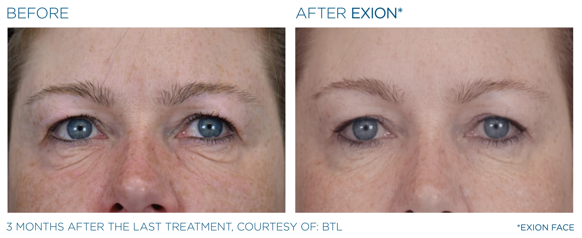 Before and after EXION Face eye-area result, courtesy BTL