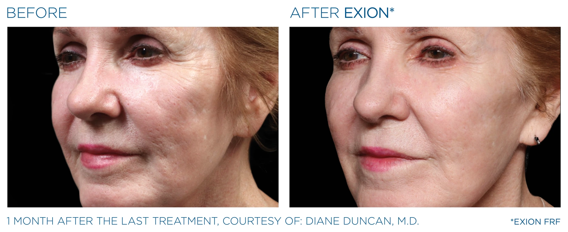 Before and after EXION RF microneedling face result, courtesy Diane Duncan, M.D.