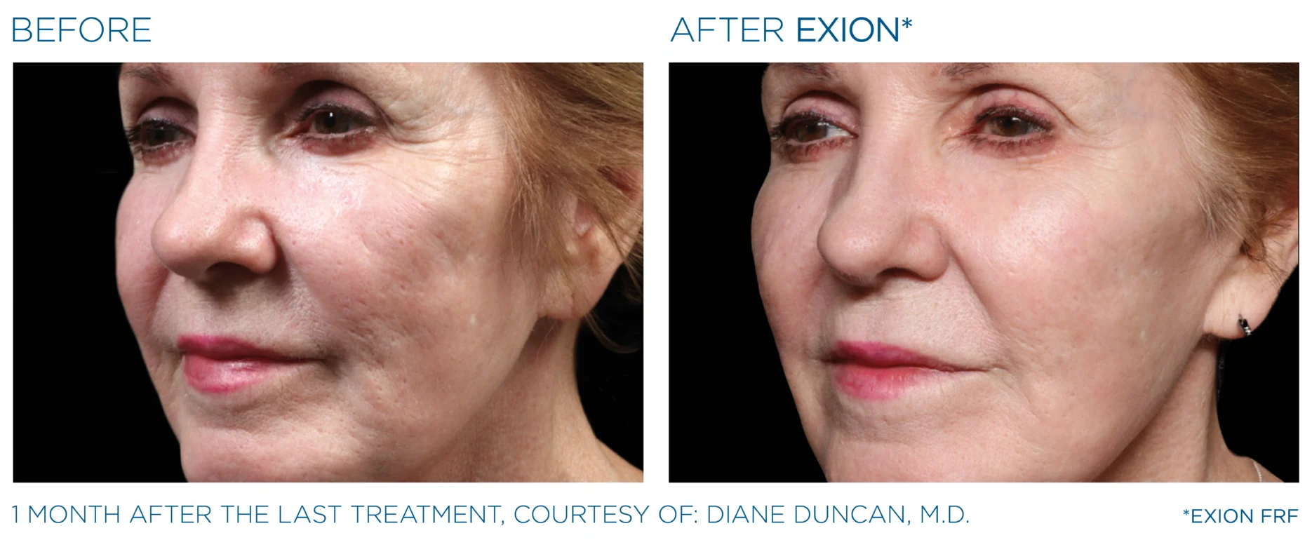 Before and after EXION RF microneedling cheek result, courtesy Diane Duncan, M.D.